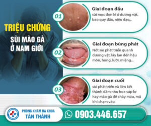 Phòng Khám Chữa Sùi Mào Gà Uy Tín Ở Phú Thọ